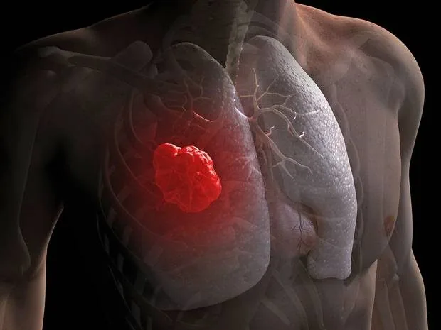 Lung cancer — lungs and airways